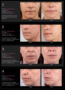 Redensity BeforeAfter